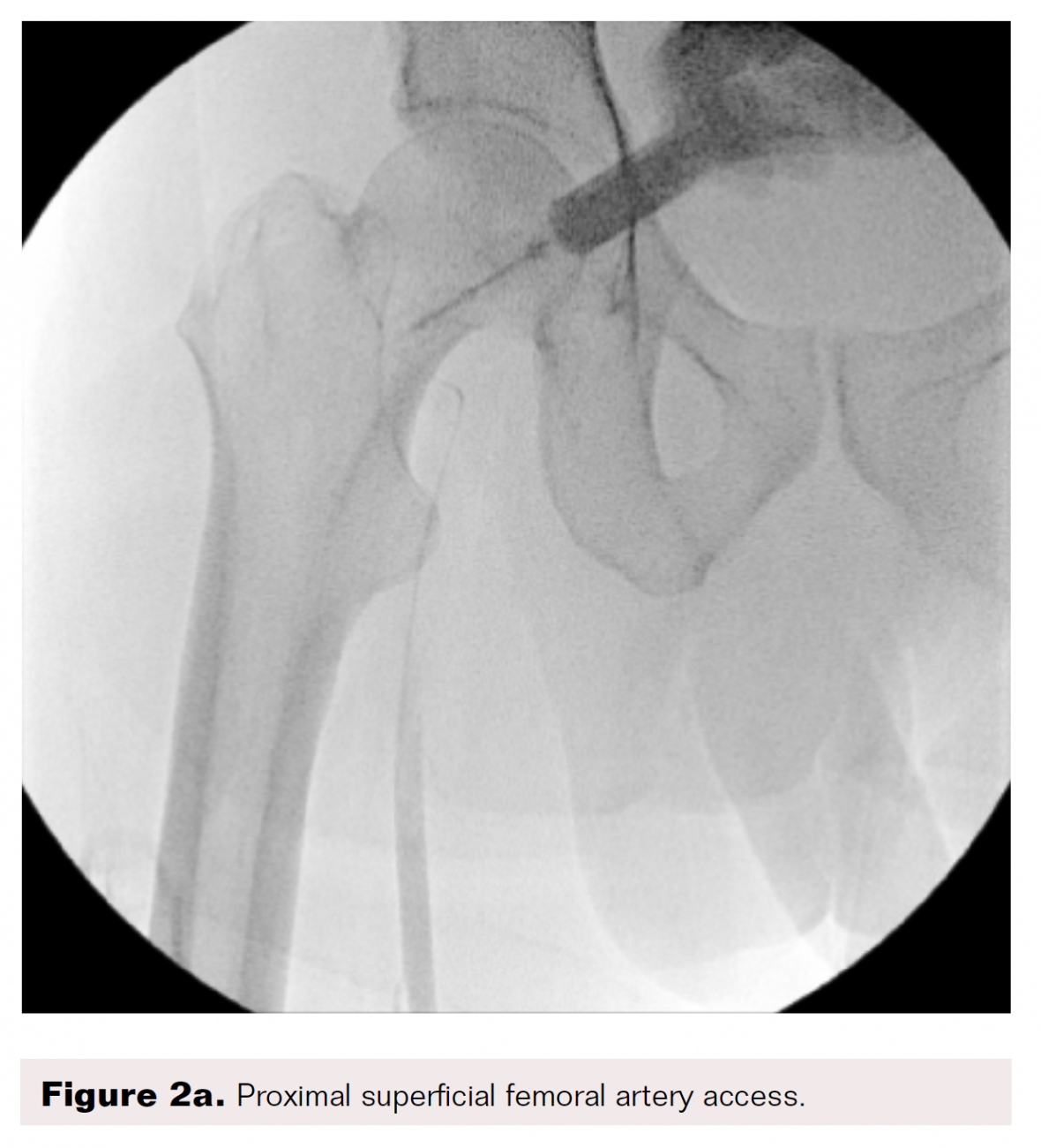 PedalPlantar Loop in Lower Extremity Angiographic Interventions